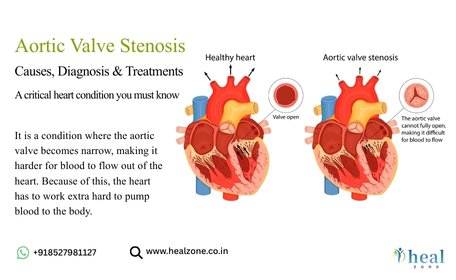 Aortic-Stenosis