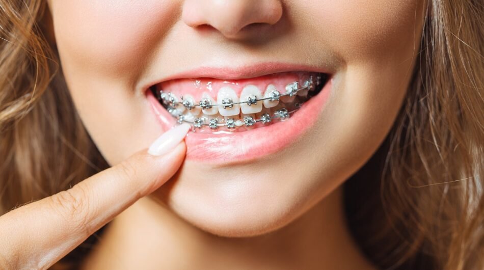 Braces-treatment-Dubai