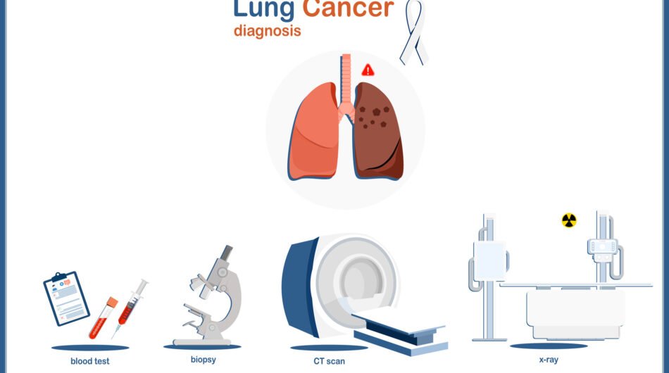 Diagnosis-of-lung-cancer