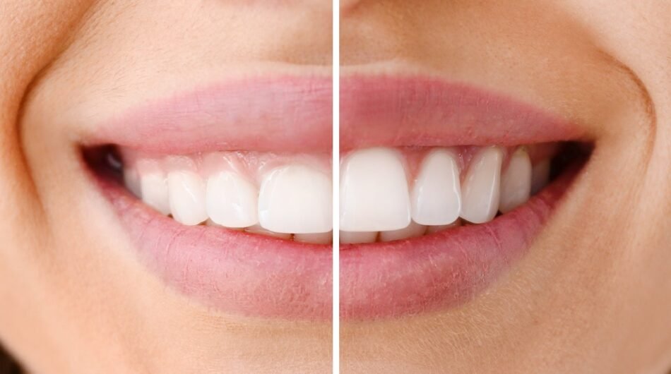 Gingivectomy-Gum-Tissue-Removal-In-Dubai