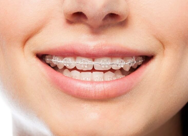 Retainer-for-teeth-alignment