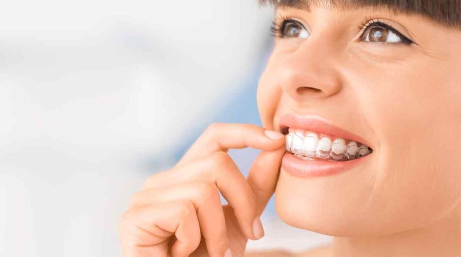 Teeth-aligners-Dubai