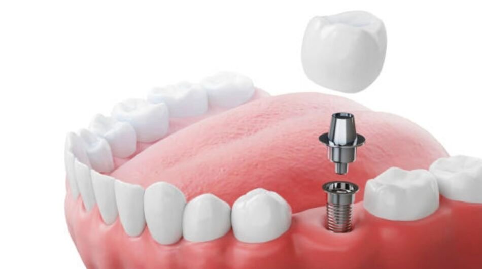 Dental-Implants-in-Mount-Roskill-Auckland