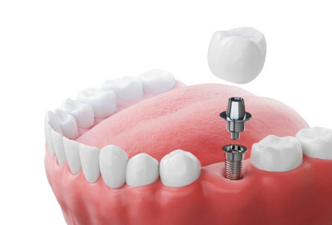 Dental Implants in Mount Roskill, Auckland