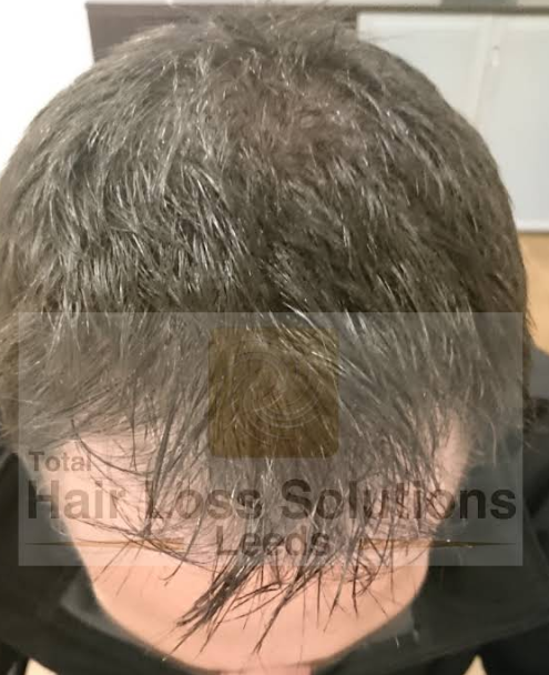 male hair implants clinic near me