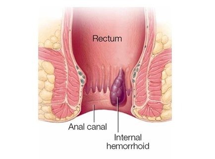 best-doctor-for-piles