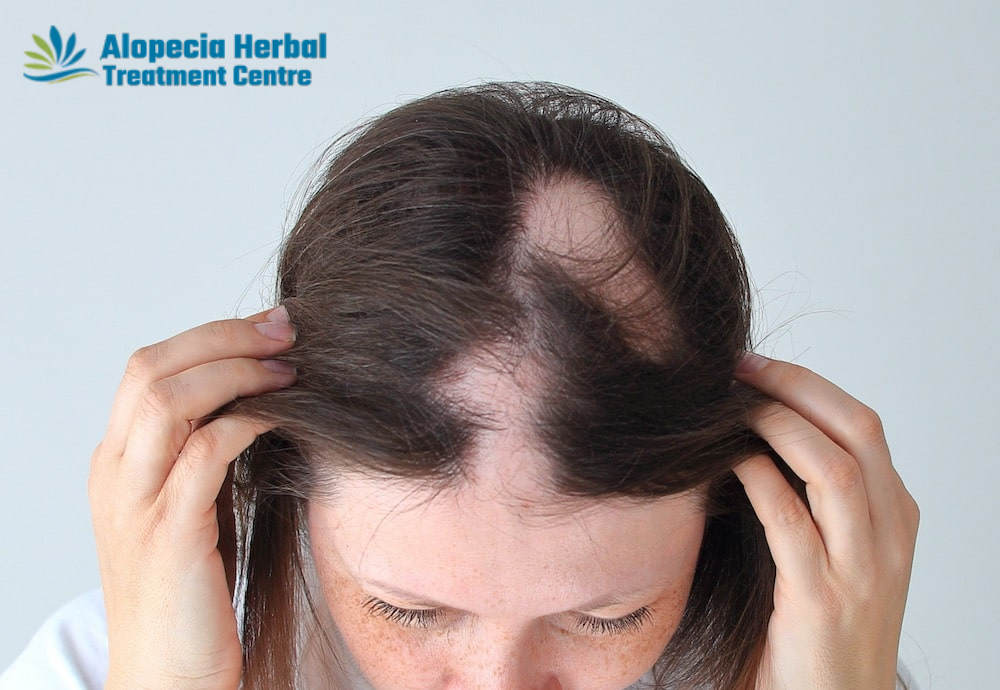 Alopecia Herbal Treatment – Herbal Hair Loss Treatment Clinic in Noida