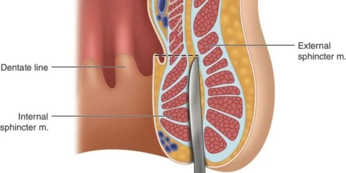 best-fistula-in-ano-treatment-in-delhi