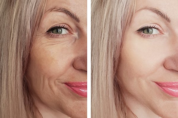 Blepharoplasty-Surgery