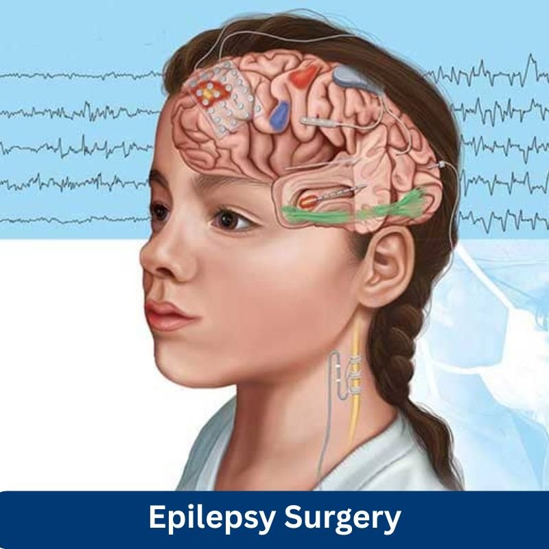 Epilepsy-Surgery
