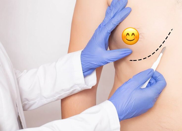 Gynecomastia-Surgery