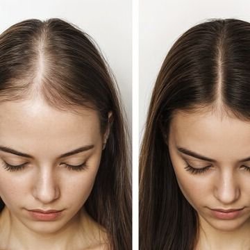 Hair-Loss-Treatment