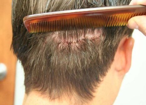 Hair-Transplant-Riyadh