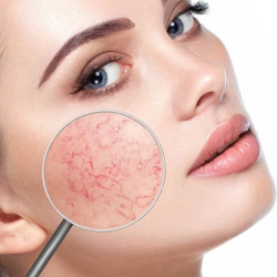 broken-capillaries-treatment-fort-collins