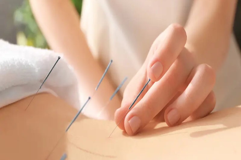 Acupuncture