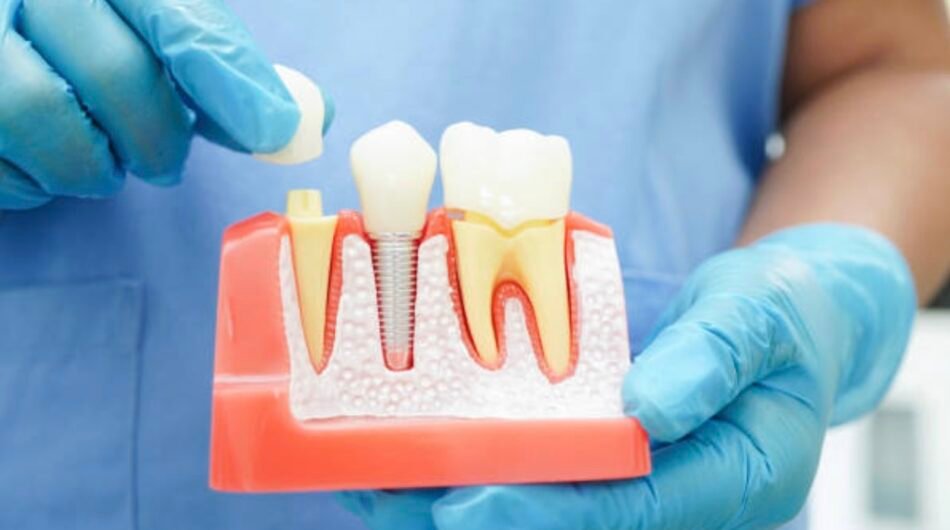 Dental-Crowns