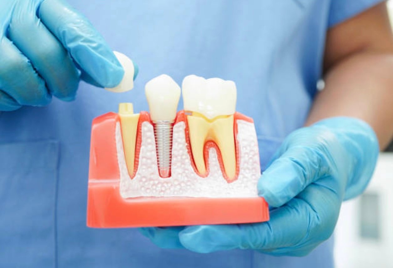 Dental Crowns Mt. Roskill, Auckland