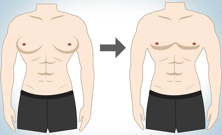 Gynecomastia-Surgery-Mumbai
