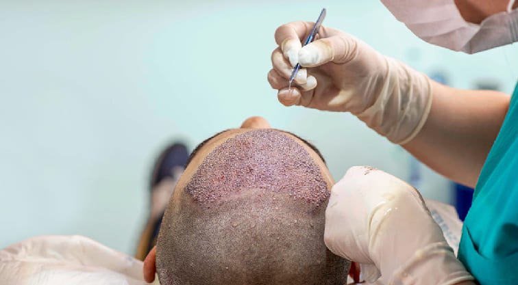 Hair-Transplant-Surgery