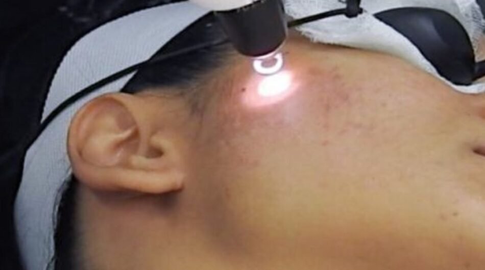 Laser-Facial-Treatment-Nearby