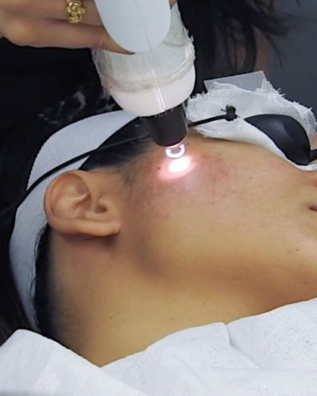 Laser Facial Treatment Nearby