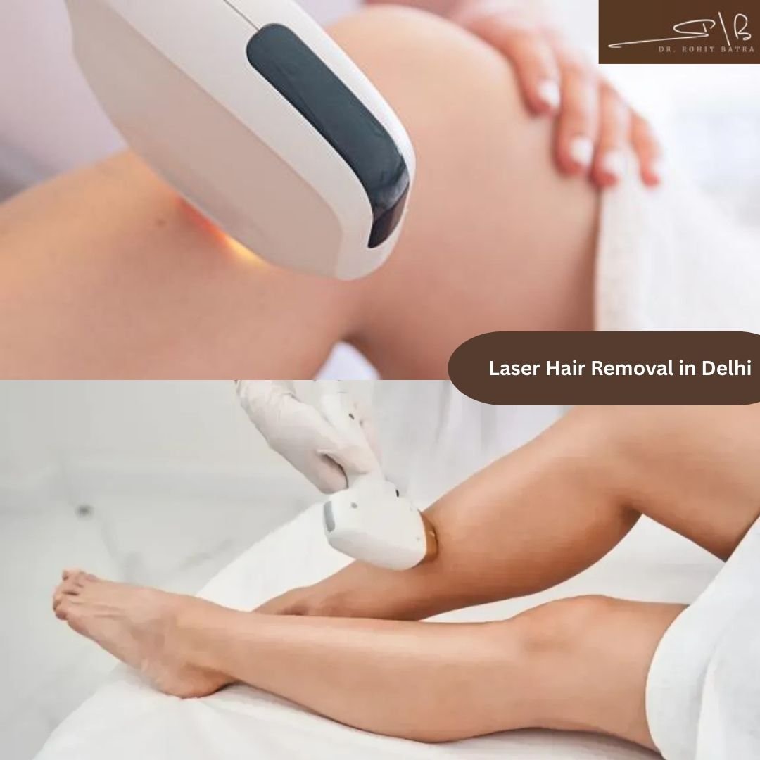 Budget-Friendly Laser Hair Removal in Delhi with Advanced Technology