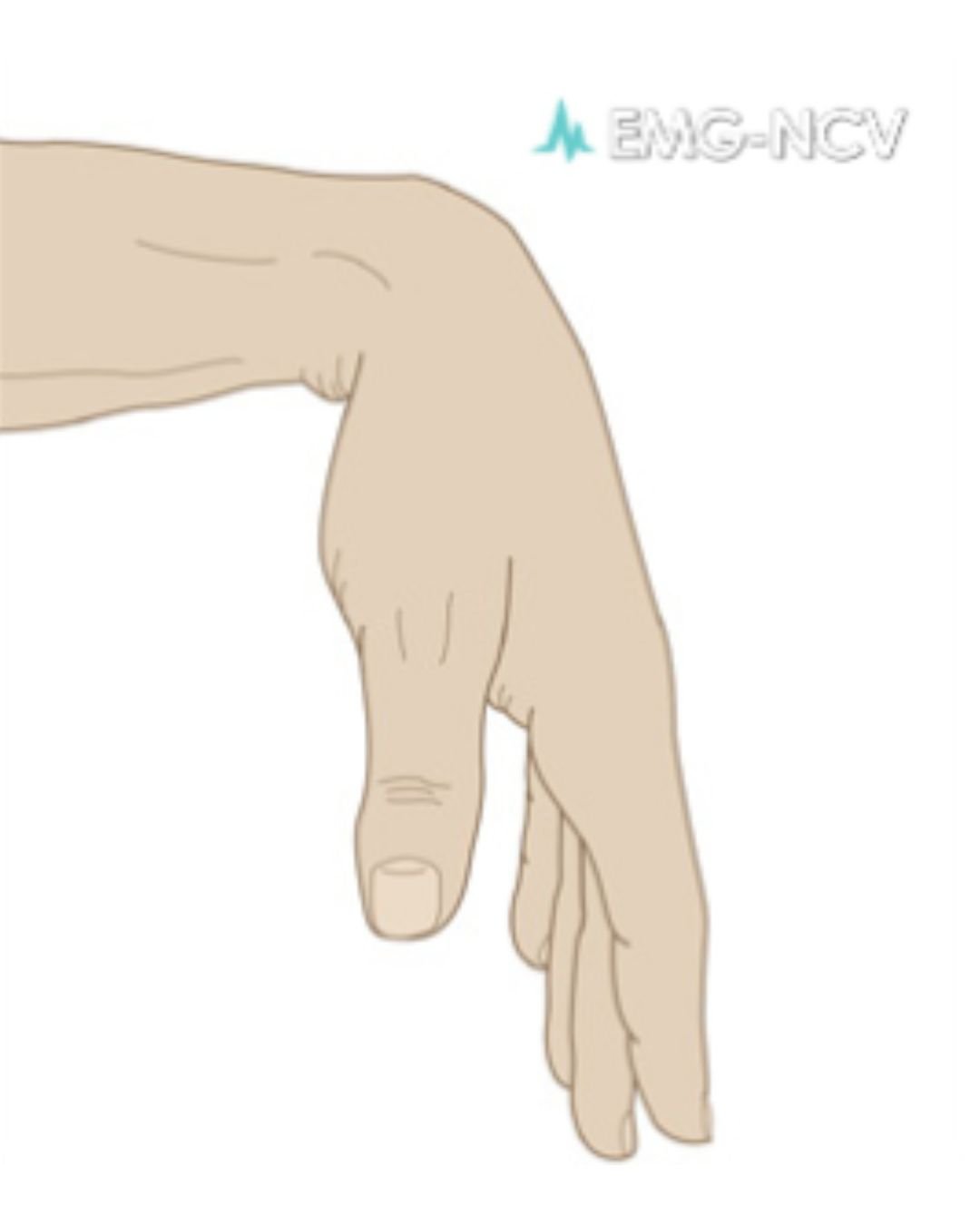 Nerve conduction study Los Angeles