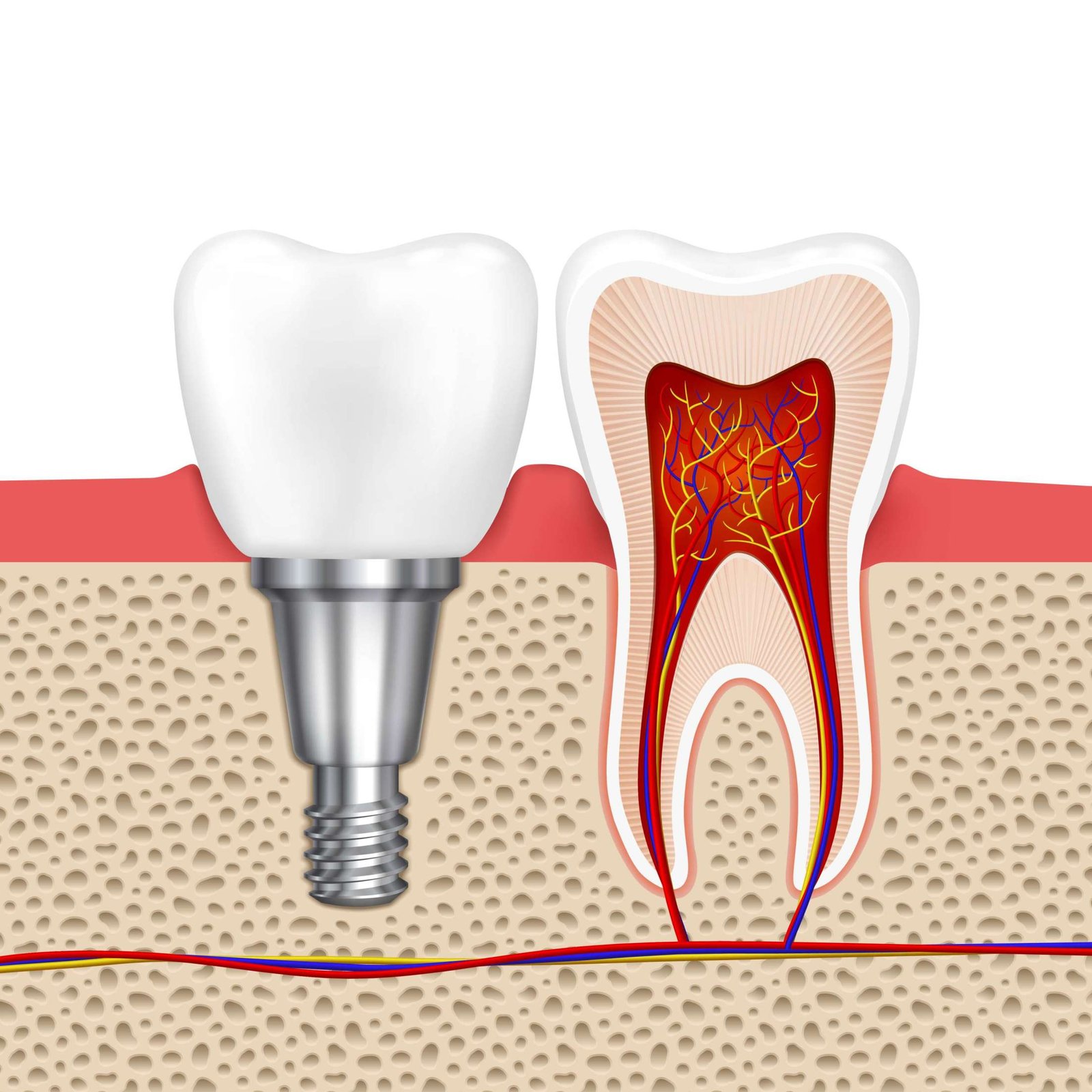 Dental Implants at White Dental Healthcare