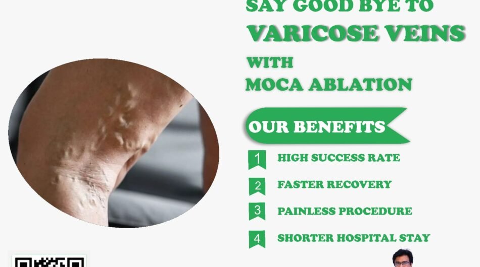 Best-Varicose-veins-treatment