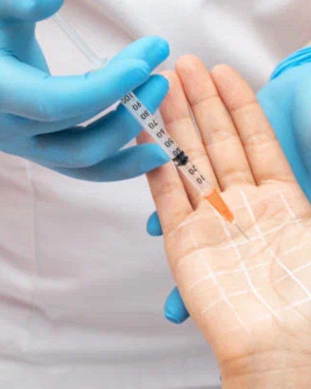 Botox For Hyperhidrosis Hands