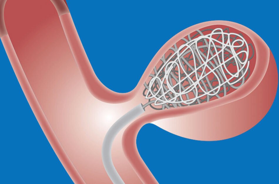Coil-Embolization-for-Brain