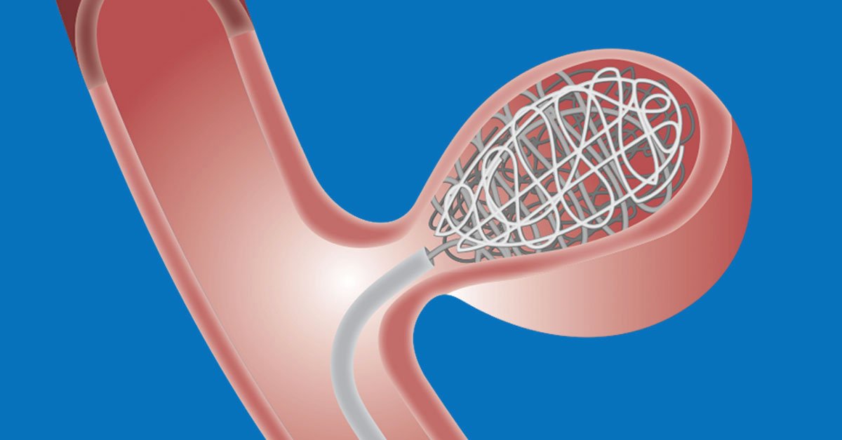 Coil Embolisation Procedure for Brain Aneurysm | Minimally Invasive Treatment