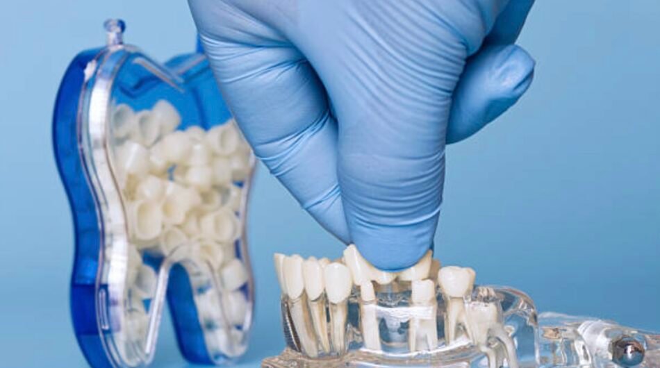 Dental-Bridges-in-Mount-Roskill-Auckland