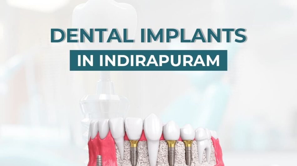 Dental-Implants-in-Indirapuram-for-Healthy-and-Strong-Teeth-1