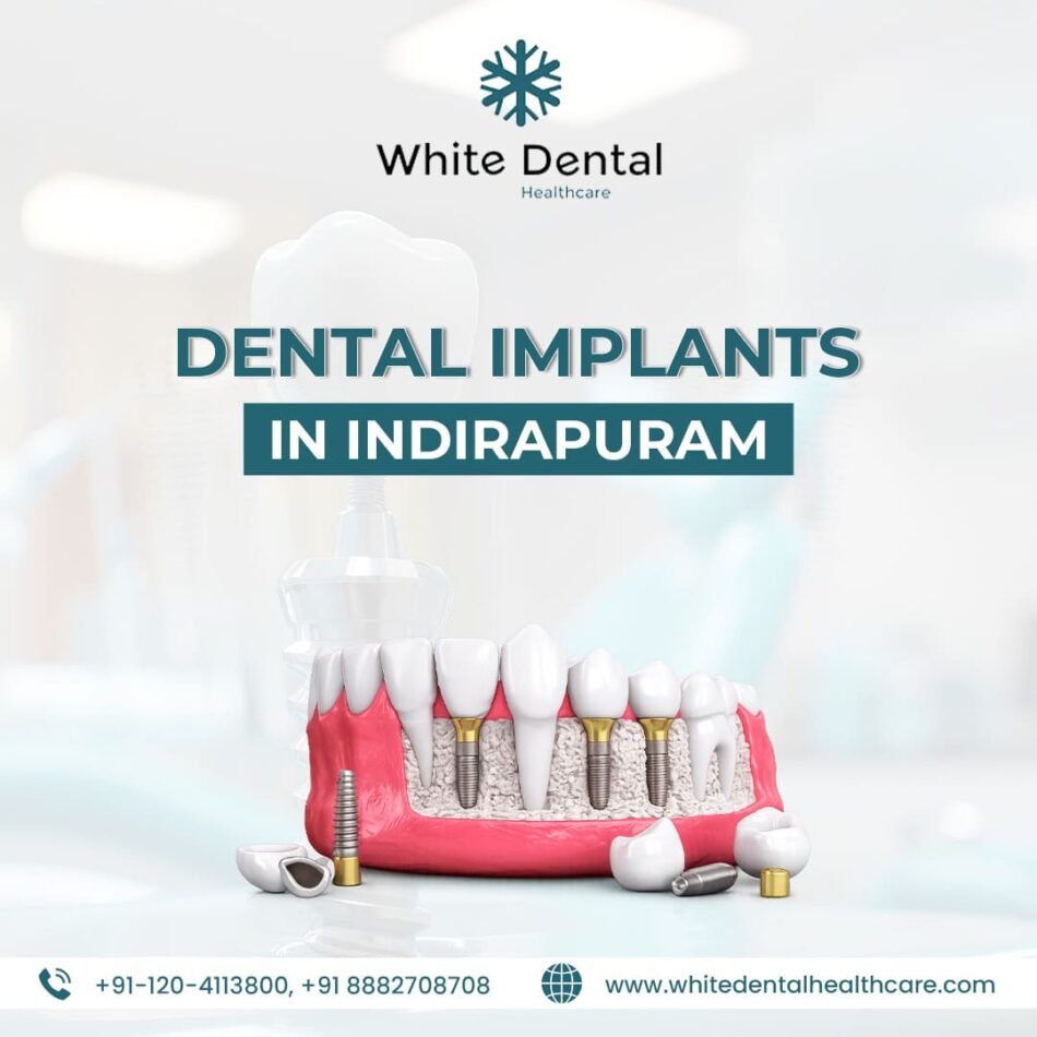 Dental-Implants-in-Indirapuram-for-Healthy-and-Strong-Teeth-1