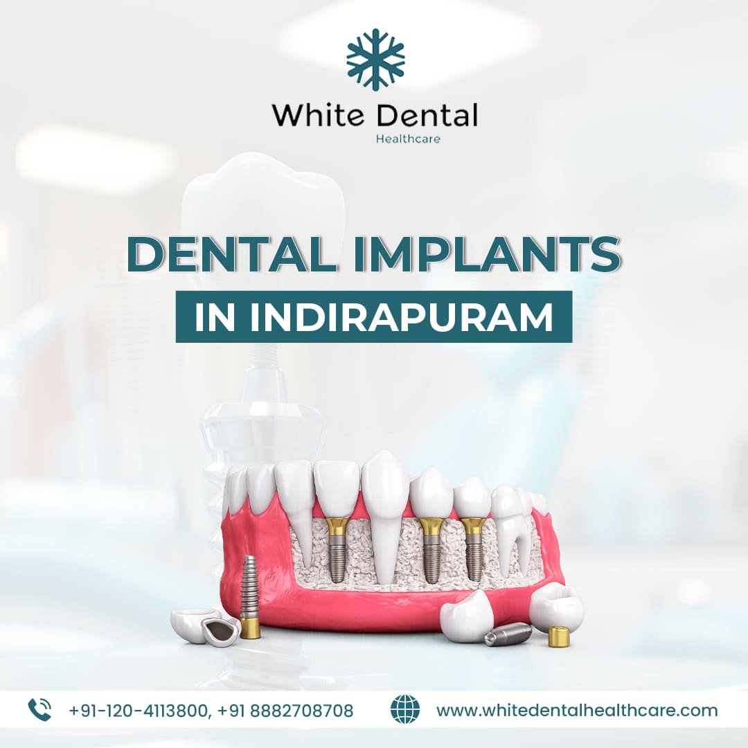Dental Implants in Indirapuram for Healthy and Strong Teeth