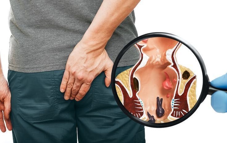 Ksharsutra-Treatment-for-Fistula