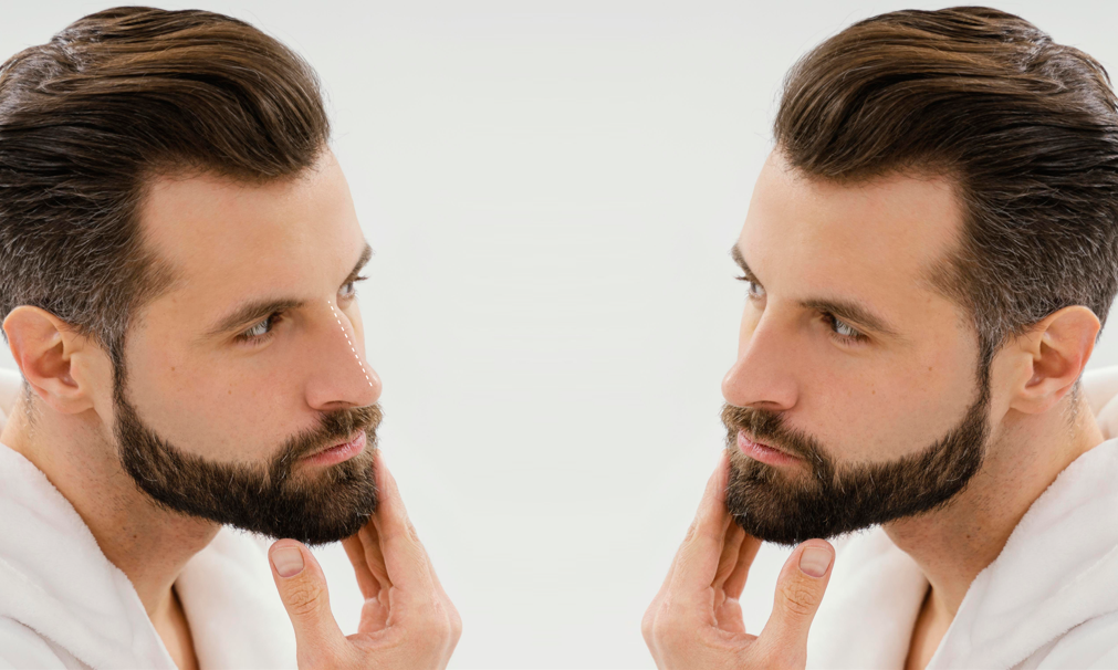 Fill Patchy Beard Areas with Expert Beard Transplant in Santa Monica