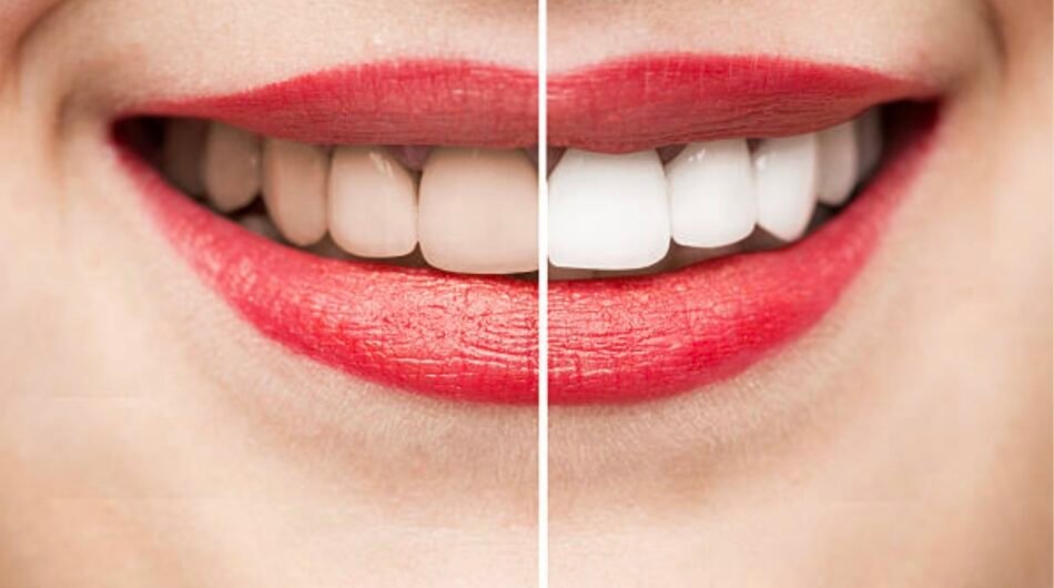 Teeth-Whitening-in-Mount-Roskill