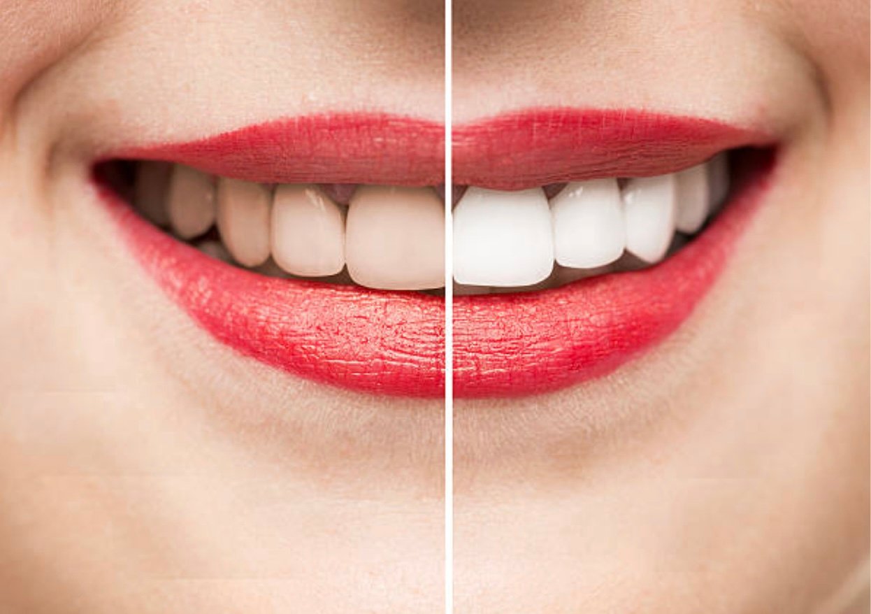 Teeth Whitening in Mount Roskill