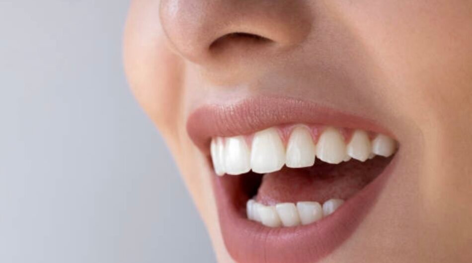 Tooth-Color-Fillings-in-Auckland