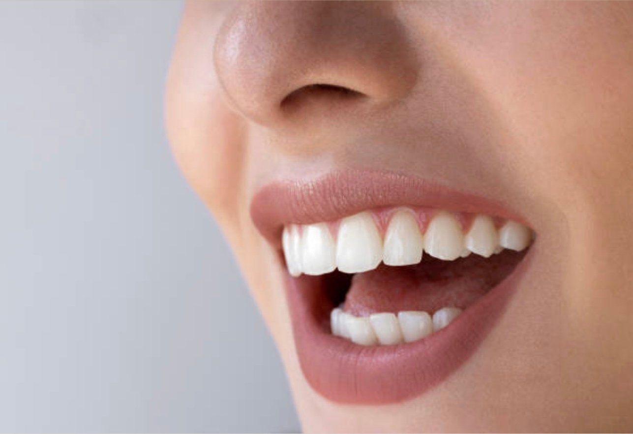 Tooth Color Fillings in Auckland
