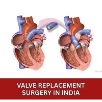 ValveReplacementSurgeryinIndia