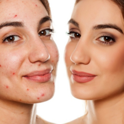 acne-treatments-fort-collins