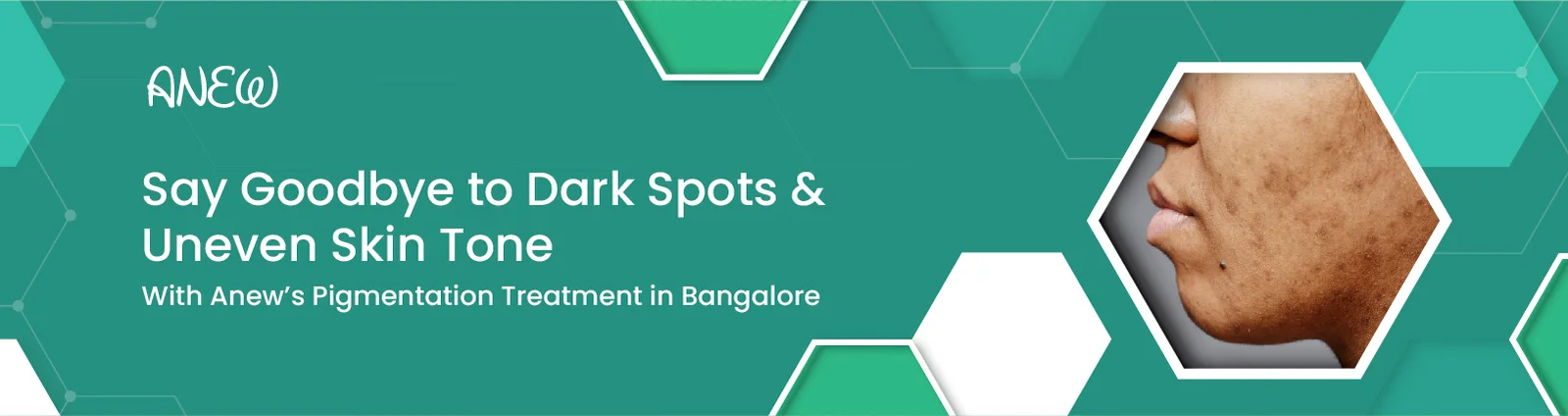 Best Pigmentation Treatment in Bangalore for Clear Skin at Anew Clinic