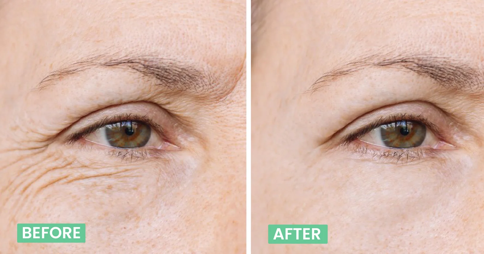 Best Botox Treatment in Bangalore – Trusted Care at Anew