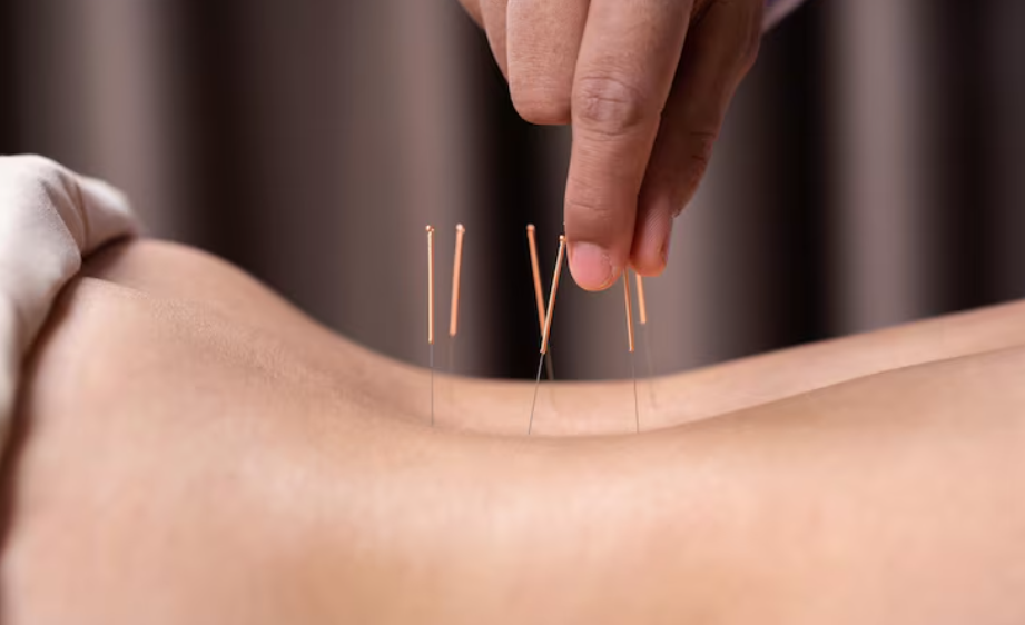 Effective relief using acupuncture for back pain therapy
