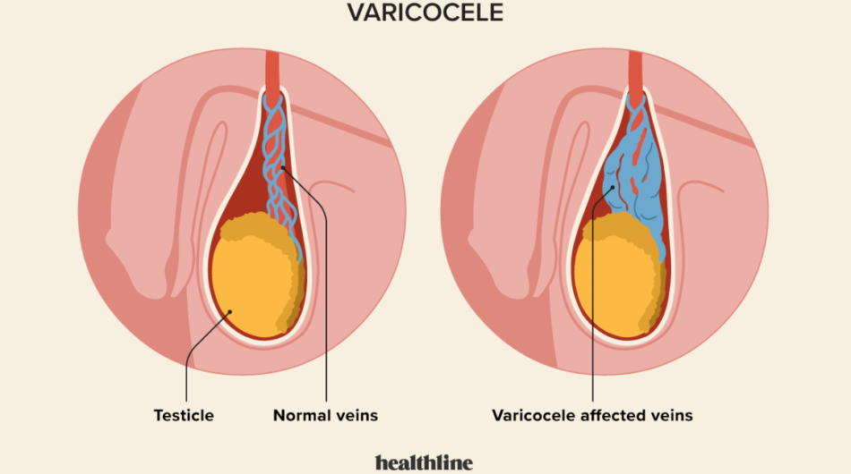 varicole-1