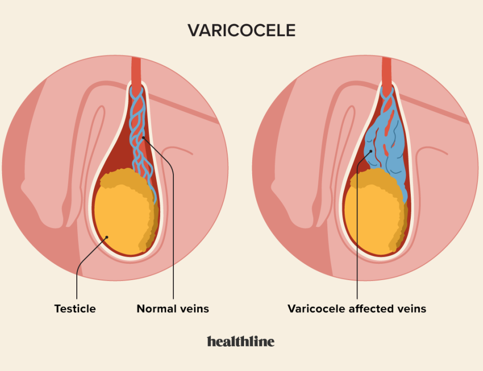 varicole-1
