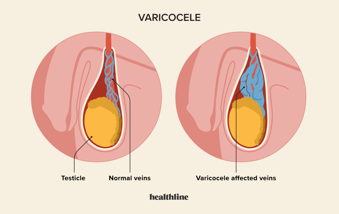 Looking for Varicocele Consultation in Lucknow? Here’s What You Need to Know